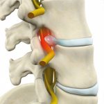 Quiropráctica y hernia discal lumbar