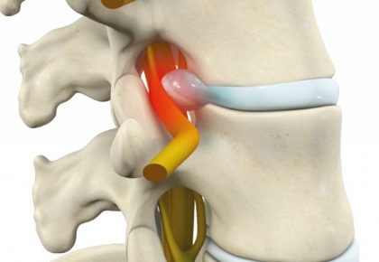 Quiropráctica y hernia discal lumbar