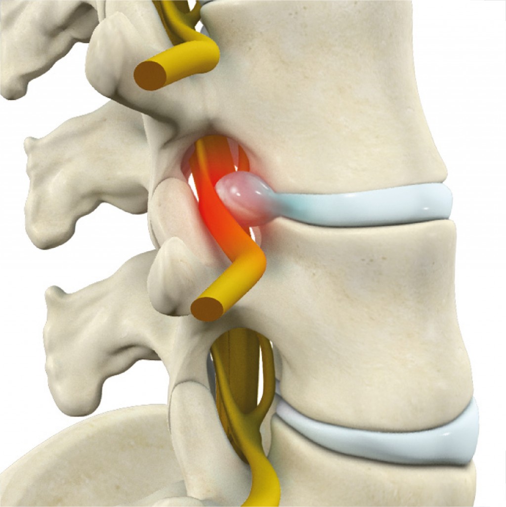 Hernia discal lumbar y tratamiento quiropráctico - Ana Quiropractica